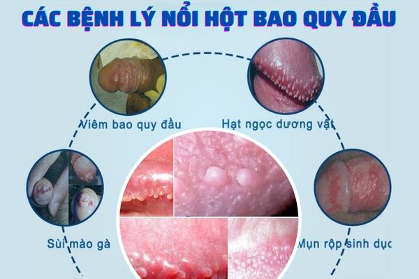 Bao quy đầu nổi hột cảnh báo nhiều bệnh lý nguy hiểm