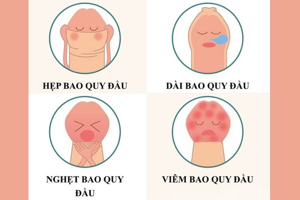 Các trường hợp bắt buộc phải cắt bao quy đầu