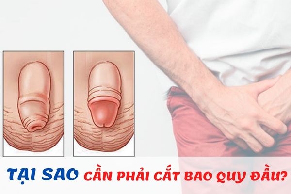 Tại sao cần phải cắt bao quy đầu? – Những lưu ý quan trọng dành cho nam giới