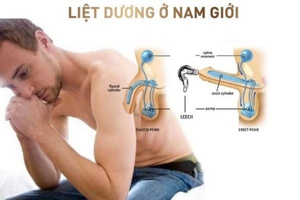 Liệt dương là bệnh lý nam khoa nguy hiểm