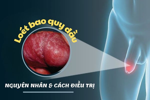 Loét bao quy đầu ở nam giới do đâu – Cách điều trị hiệu quả