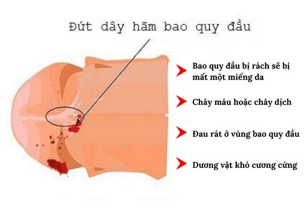 Biểu hiện rách bao quy đầu