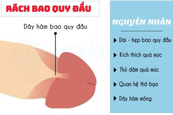 Rách bao quy đầu do nhiều nguyên nhân khác nhau gây ra