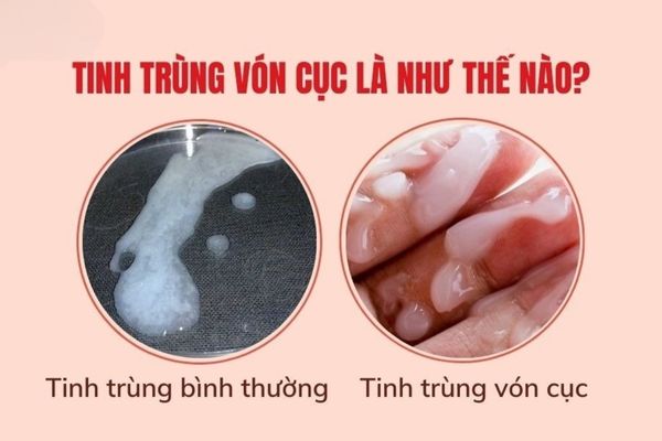 Tinh trùng vón cục là triệu chứng thường gặp ở nam giới