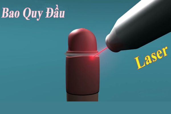 Chữa dài bao quy đầu bằng tia laser