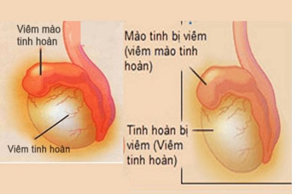 Đau dương vật do viêm mào tinh hoặc viêm tinh hoàn