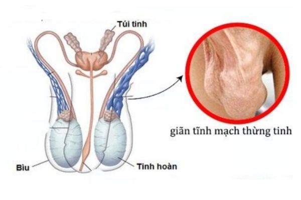 Giãn tĩnh mạch thừng tinh gây đau tinh hoàn kéo dài