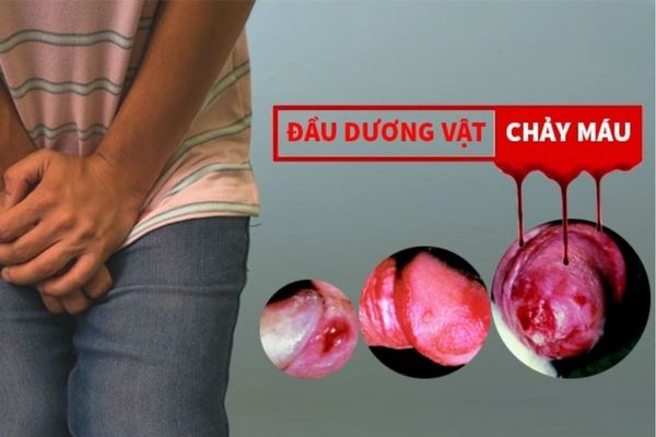 Vì sao dương vật chảy máu? Cách điều trị hiệu quả nhất