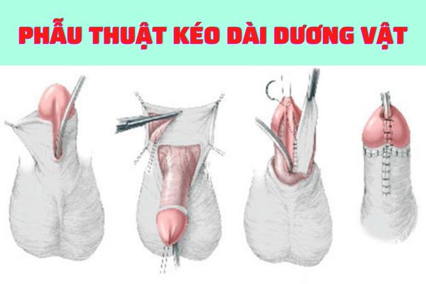 Phẫu thuật kéo dài kích thước dương vật