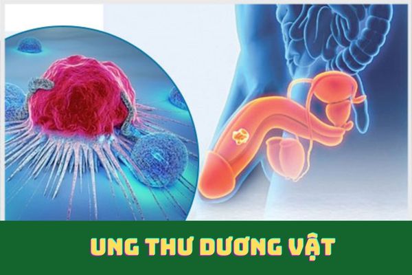 Ung thư dương vật là bệnh lý nguy hiểm cần phải đề phòng