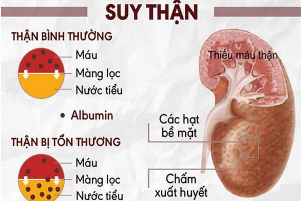 Suy thận là bệnh lý hàng đầu gây tiểu đêm ở nam giới