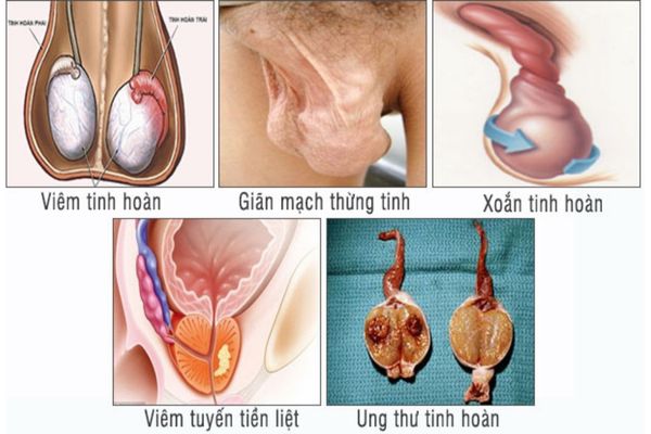 Đau 1 bên tinh hoàn do nhiều nguyên nhân khác nhau gây ra