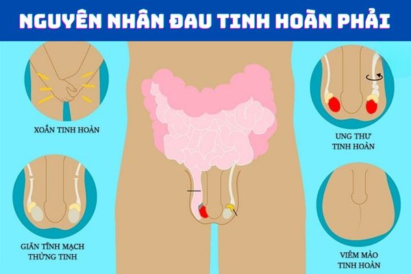 Đau tinh hoàn phải cảnh báo nhiều bệnh lý nguy hiểm 