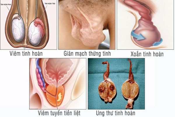 Đau tinh hoàn trái cảnh báo nhiều bệnh lý nguy hiểm