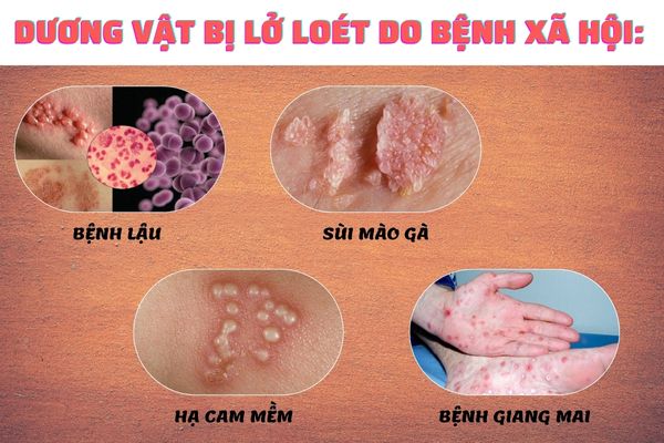 Bệnh xã hội khiến dương vật bị lở loét, khó chịu