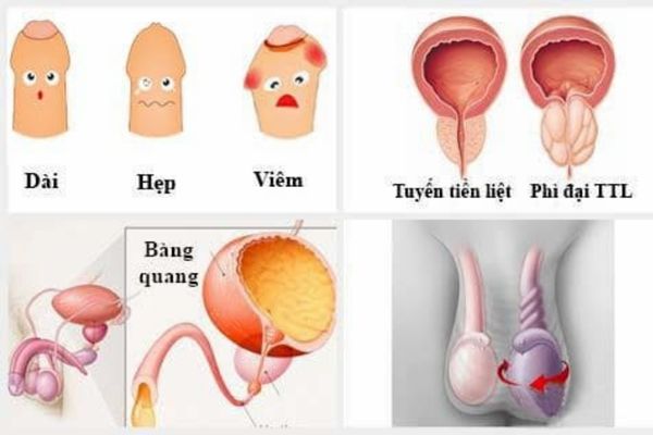 Các bệnh lý dương vật phổ biến ở nam giới