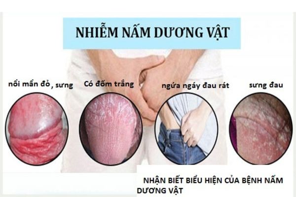 Nấm dương vật gây ngứa rát cậu nhỏ kéo dài