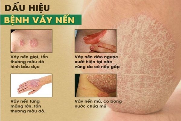 Bệnh vảy nến sinh dục cần được phát hiện và điều trị sớm