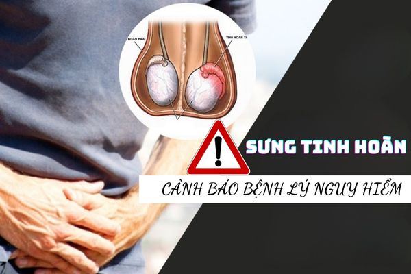 Sưng tinh hoàn – Dấu hiệu cảnh báo bệnh nam khoa nguy hiểm