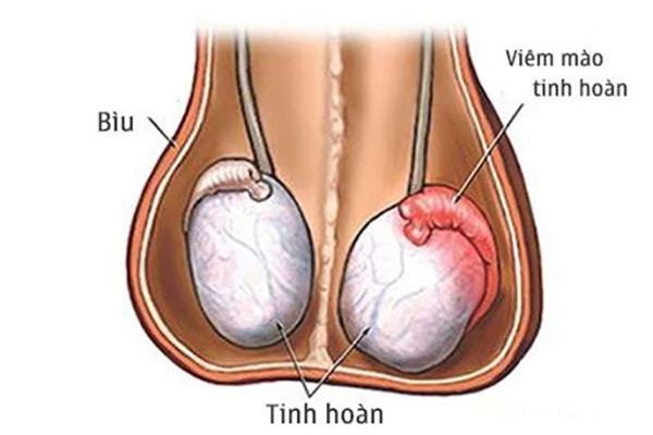 Viêm tinh hoàn dẫn đến hiện tượng teo tinh hoàn