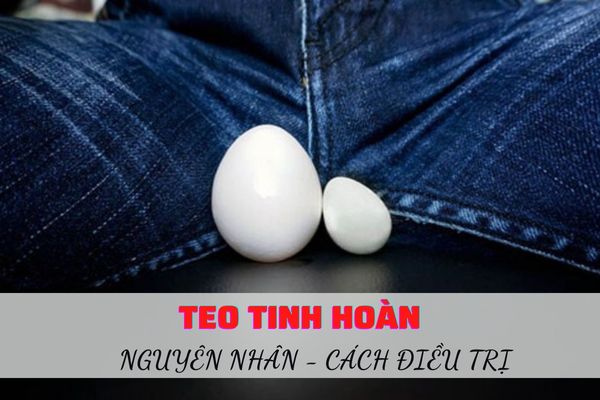 Teo tinh hoàn – Nguyên nhân bệnh lý và cách điều trị hiệu quả