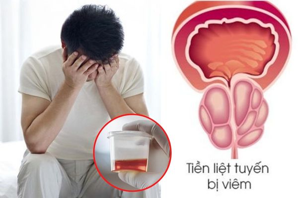 Viêm tuyến tiền liệt gây ra tình trạng xuất tinh ra máu