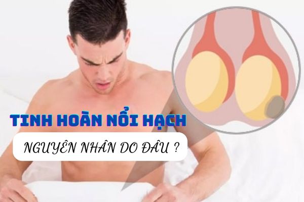 Lý giải nguyên nhân tinh hoàn nổi hạch thường gặp ở nam giới