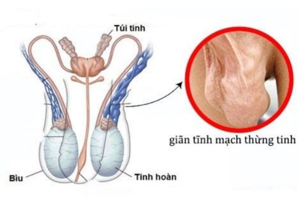 Giãn tĩnh mạch thừng tinh là nguyên nhân chính gây u tinh hoàn