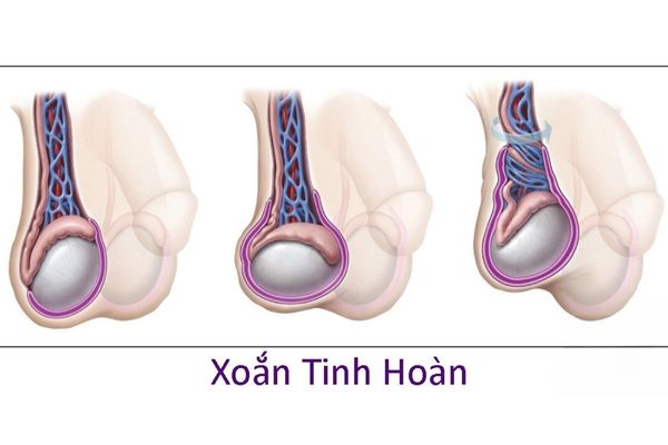 U mào tinh do xoắn tinh hoàn gây ra