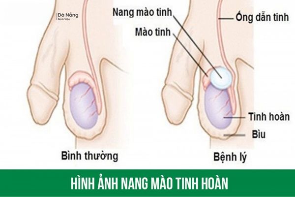 Nang mào tinh hoàn là bệnh lý nguy hiểm 