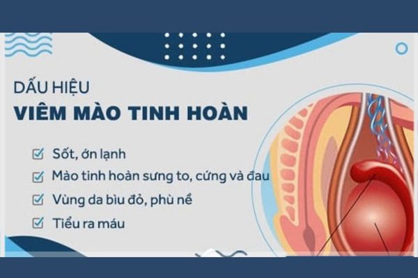 Dấu hiệu nhận biết viêm mào tinh hoàn ở nam giới