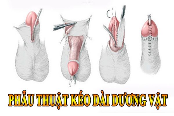 Phương pháp phẫu thuật kéo dài dương vật