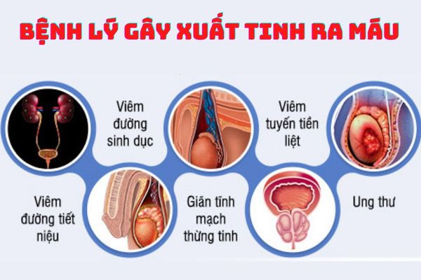 Xuất tinh ra máu cảnh báo cho nhiều bệnh lý nguy hiểm