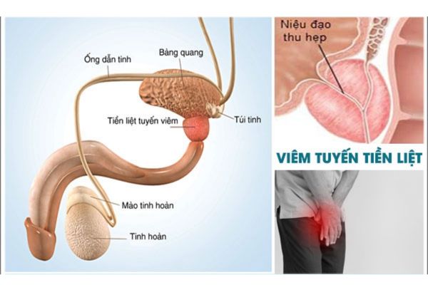 Viêm tuyến tiền liệt là bệnh thường gặp phải ở nam giới