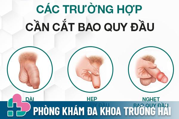 Trường hợp nam giới cần nên thực hiện cắt bao quy đầu