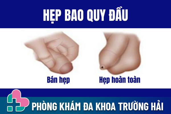 Hep-bao-quy-dau-hoi-chung-nguy-hiem-pho-bien-o-nam-gioi-1