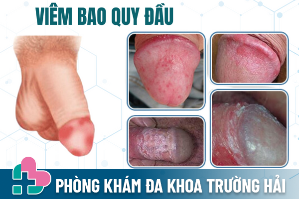 Viêm bao quy đầu: Dấu hiệu và nơi điều trị hiệu quả