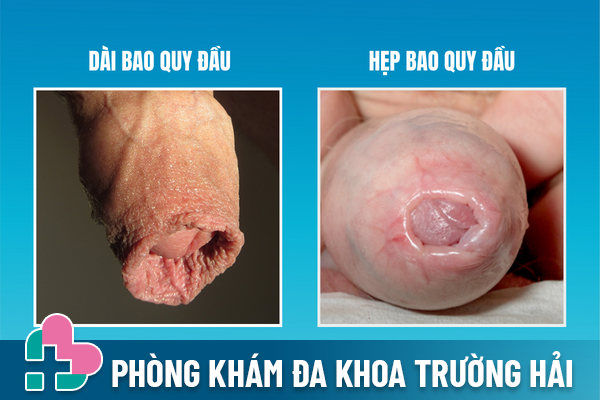 Tuot-bao-quy-dau-kho-khan-do-dau-va-giai-quyet-ra-sao-1