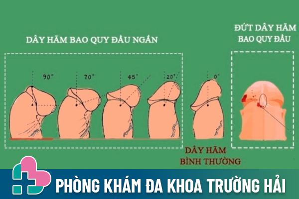 Những điều cần biết về hiện tượng đứt dây hãm bao quy đầu